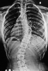 Scoliosis