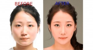 Plastic Surgery in Korea