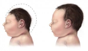 Microcephaly comparison | Courtesy of Wikimedia