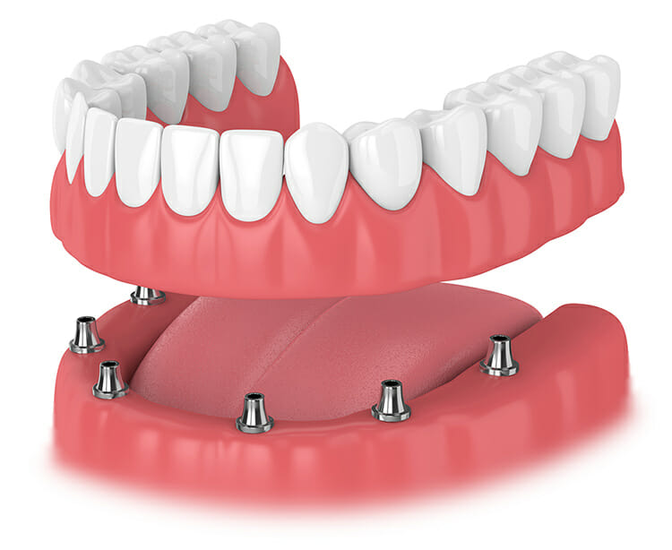 Denture Supporting Implants