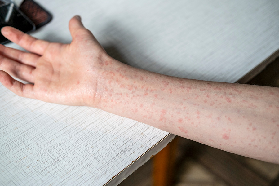 Outbreak Response Immunisation Commences in Sumenep, East Java, to Combat Measles