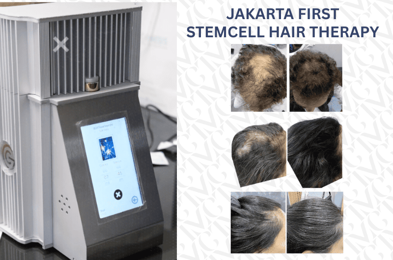 Stem-Cell Hair Therapy