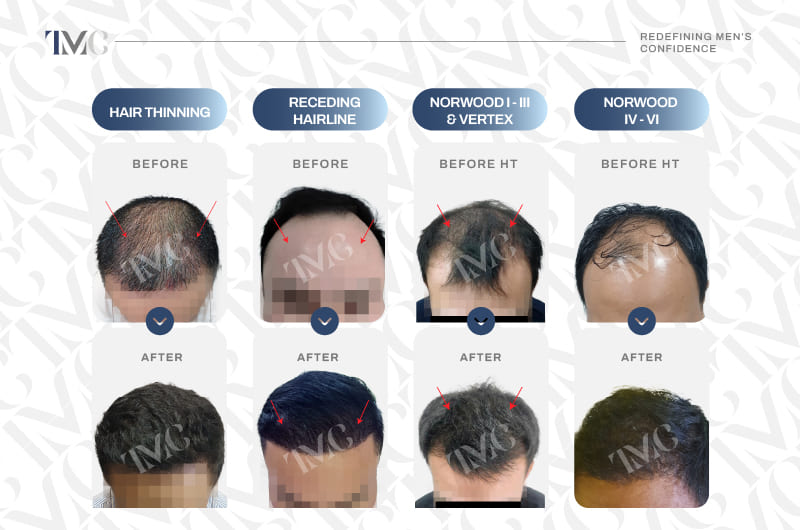MAXX GRAFTS