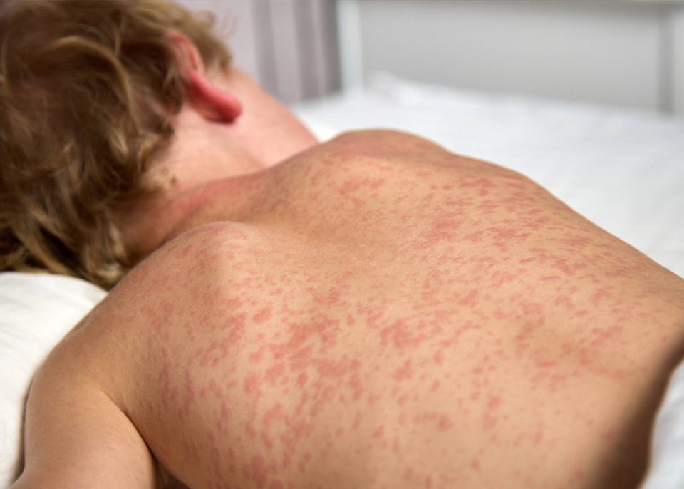 Two Foreign Nationals Test Positive for Measles After Returning from Indonesia