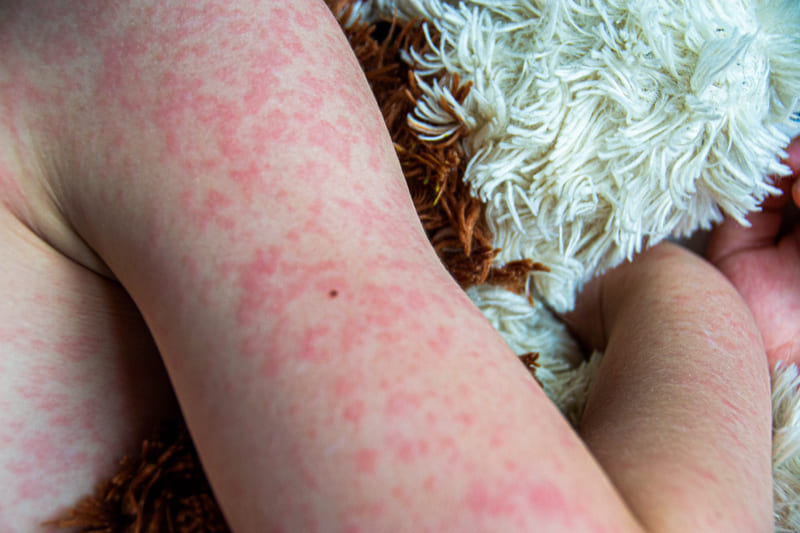 Measles in Children is Increasing: Recognise the Symptoms, Transmission, and Prevention