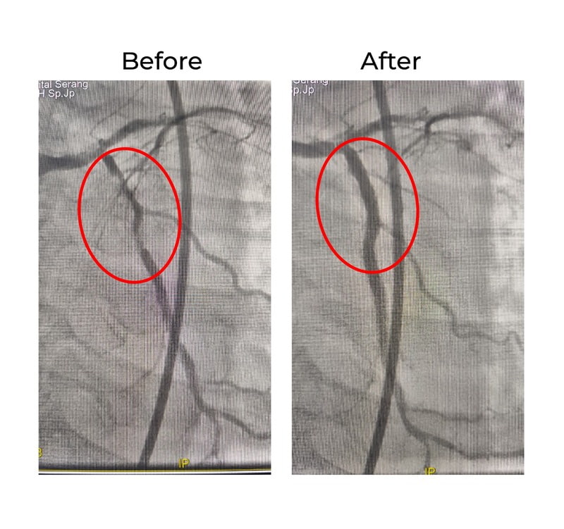 Stent Expansion