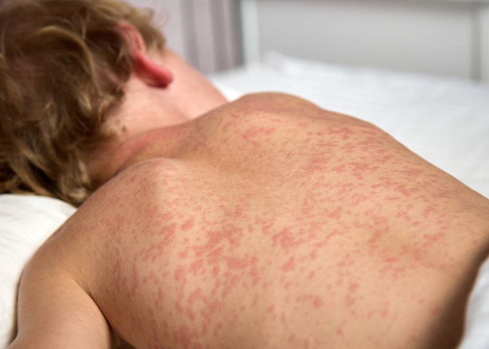 Beware of Measles in Children: Vaccination Is the Key to Primary Protection